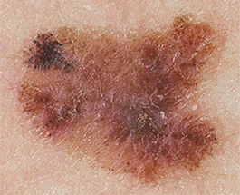 melanoma warning signs