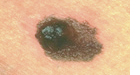 Elevated melanoma