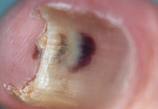 Melanoma under toenail