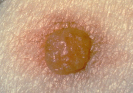 A raised atypical mole